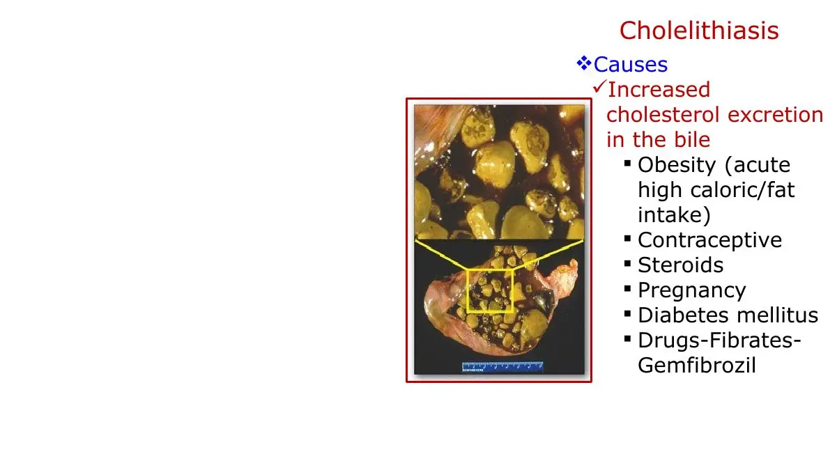Causes that raise biliary cholesterol: obesity, hormones, diabetes, fibrates