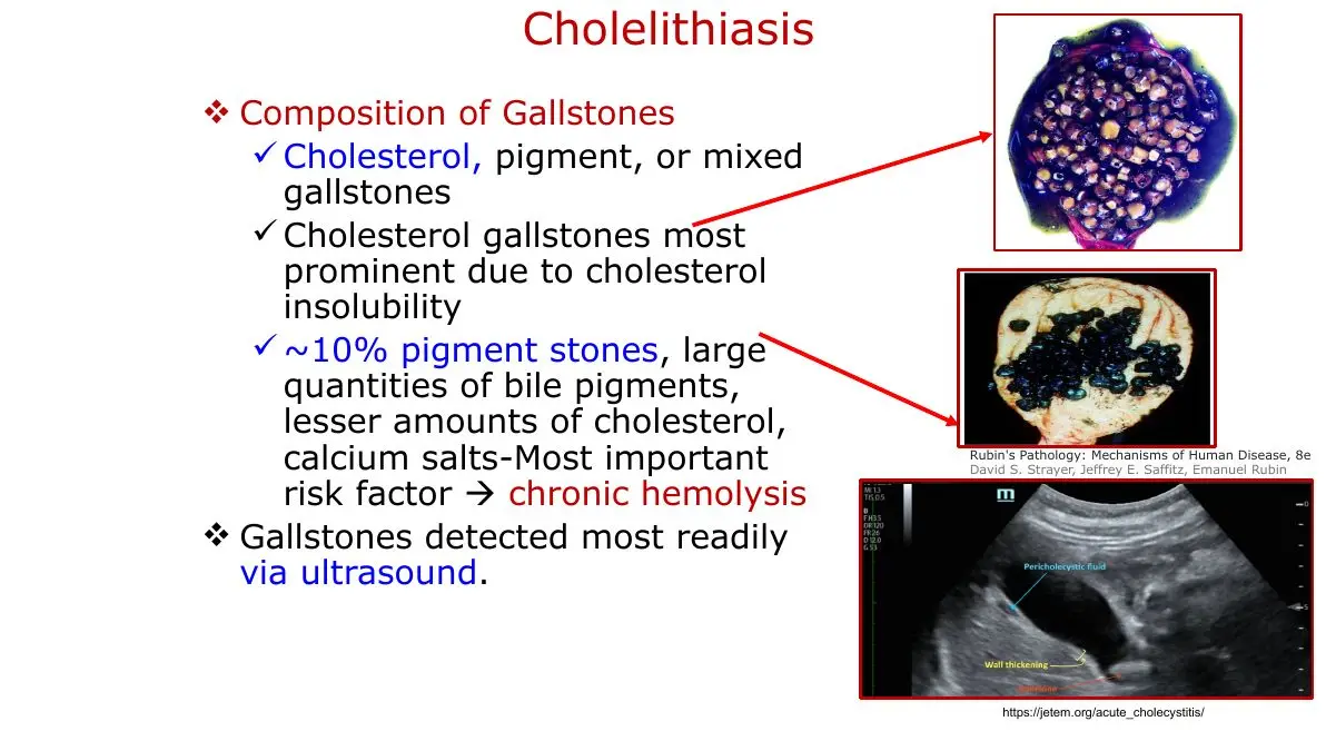 Cholesterol, pigment and mixed stones; ultrasound detects them