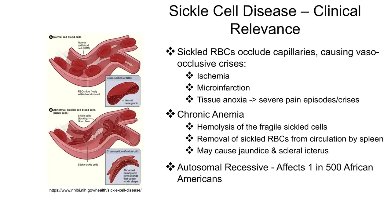 Lecture: vaso-occlusive crises, chronic haemolytic anaemia, jaundice; autosomal recessive, 1 in 500