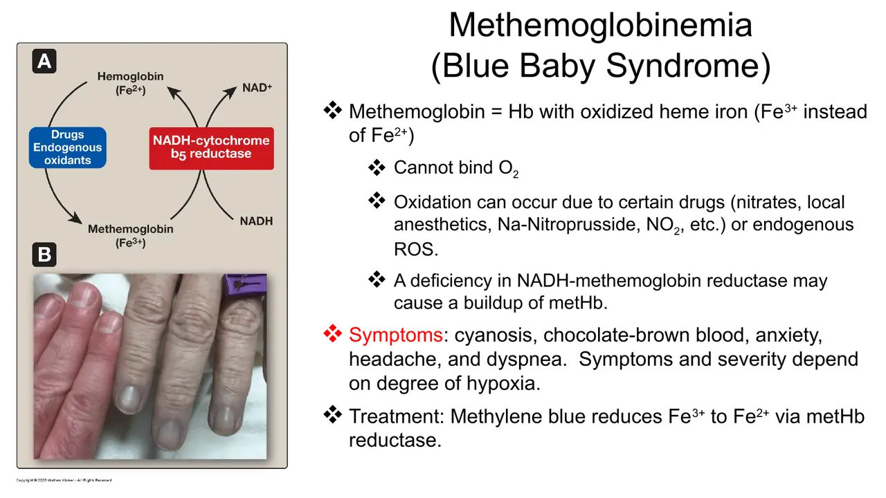 Methaemoglobinaemia: oxidising drugs, reductase deficiency, cyanosis, chocolate-brown blood; methylene blue treats.