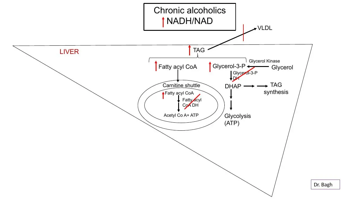 Alcohol: ↑NADH/NAD+ raises glycerol 3-phosphate and fatty acyl-CoA; more TAG; VLDL export blocked.