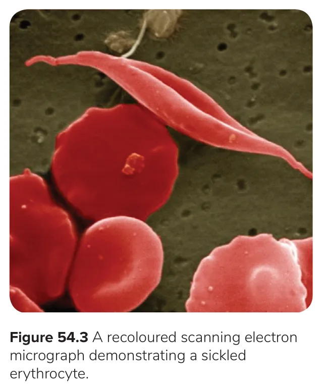 Osmosis: electron micrograph of a sickled red cell