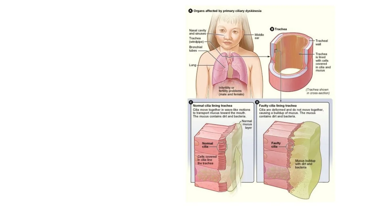 Vidal: primary ciliary dyskinesia, organs affected; normal vs faulty cilia with mucus buildup