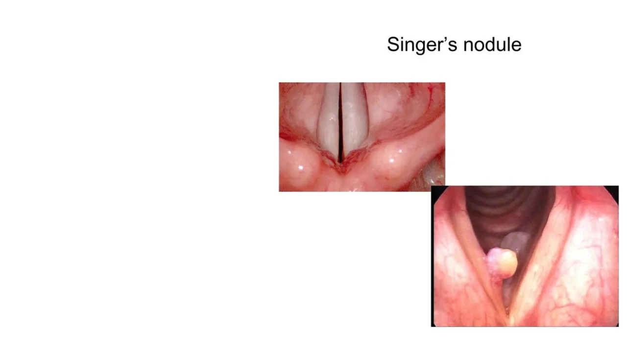 Vidal: singer's nodules, callus-like growths at the midpoint of the vocal folds