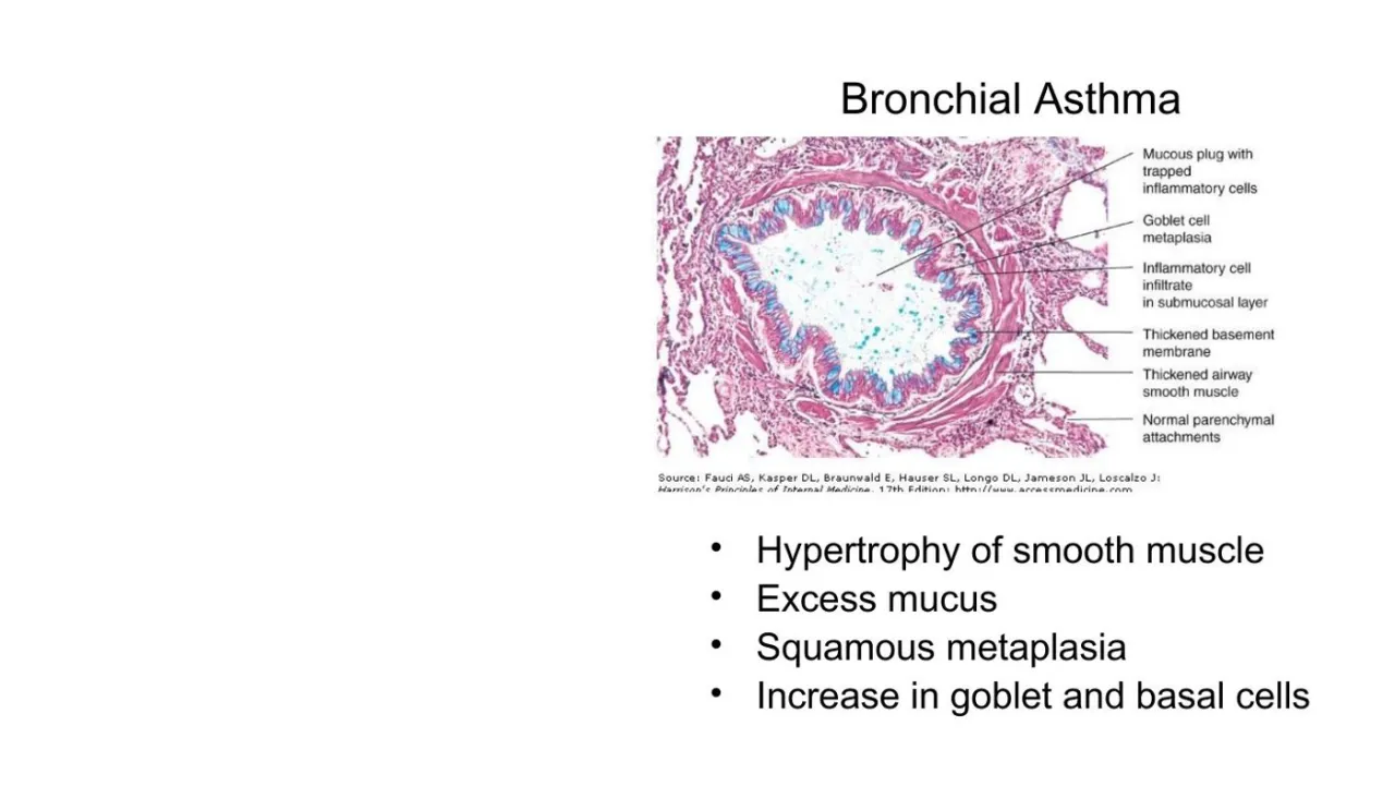 Vidal: bronchial asthma, thick smooth muscle and BM, goblet cells, mucus plug, inflammatory cells