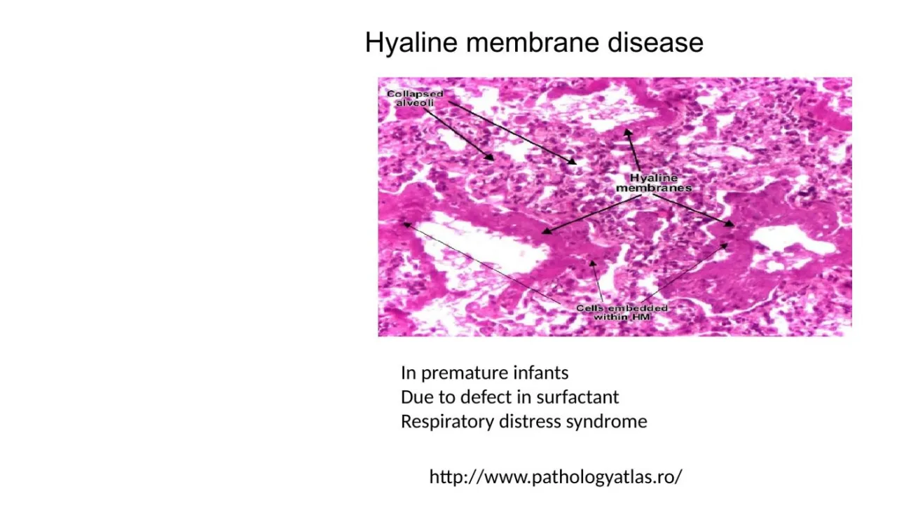 Lecture: hyaline membrane disease in premature infants due to surfactant defect (RDS)