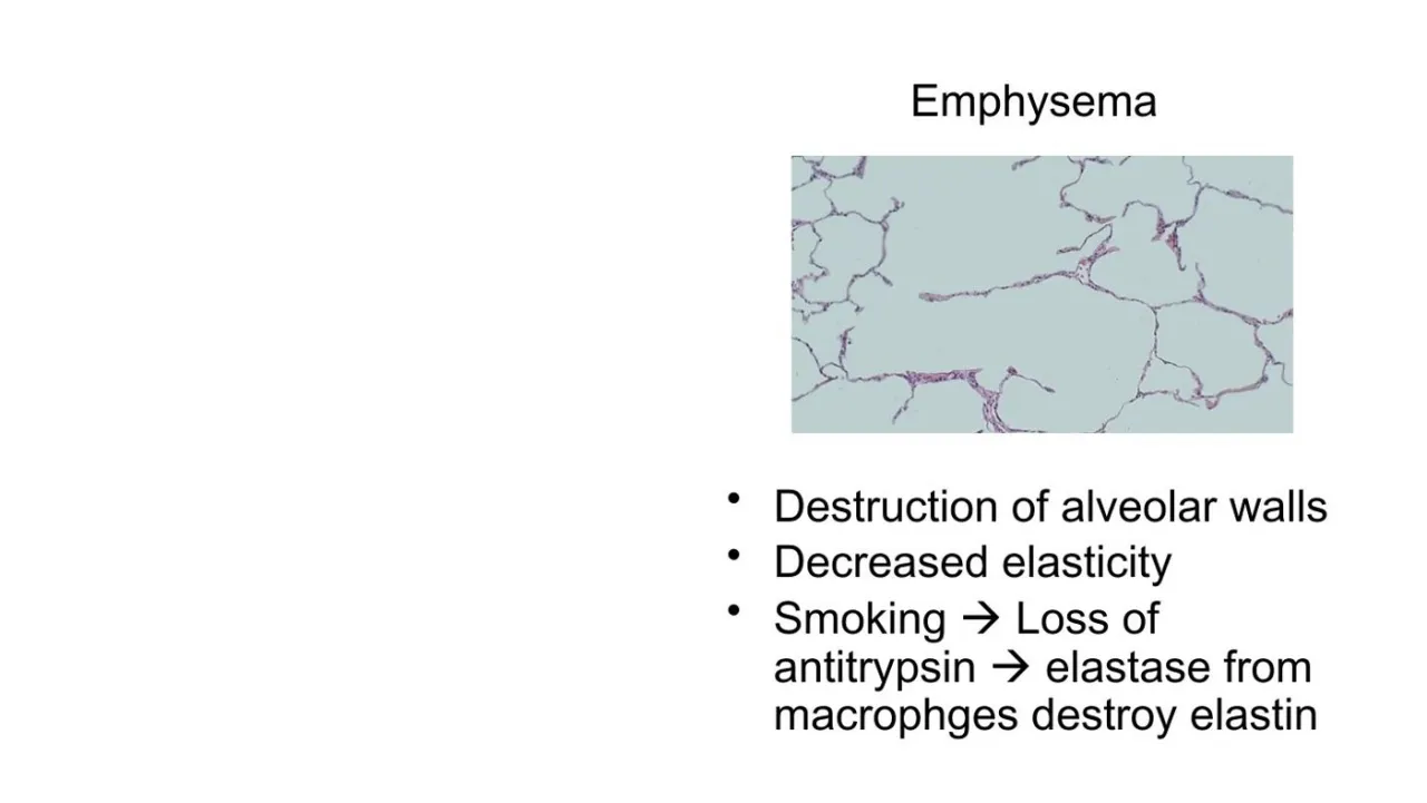 Lecture: emphysema, destroyed alveolar walls; smoking, loss of antitrypsin, macrophage elastase