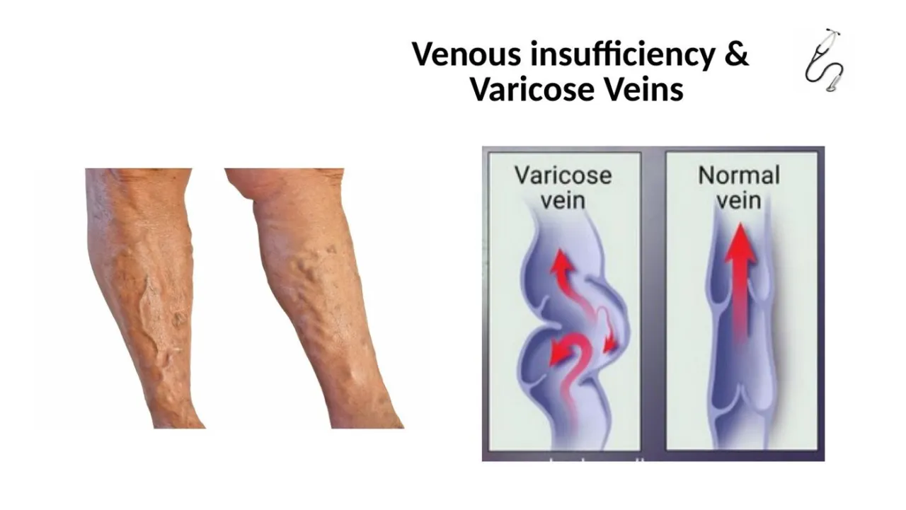Lecture: varicose vein with failed valves and backflow beside a normal vein