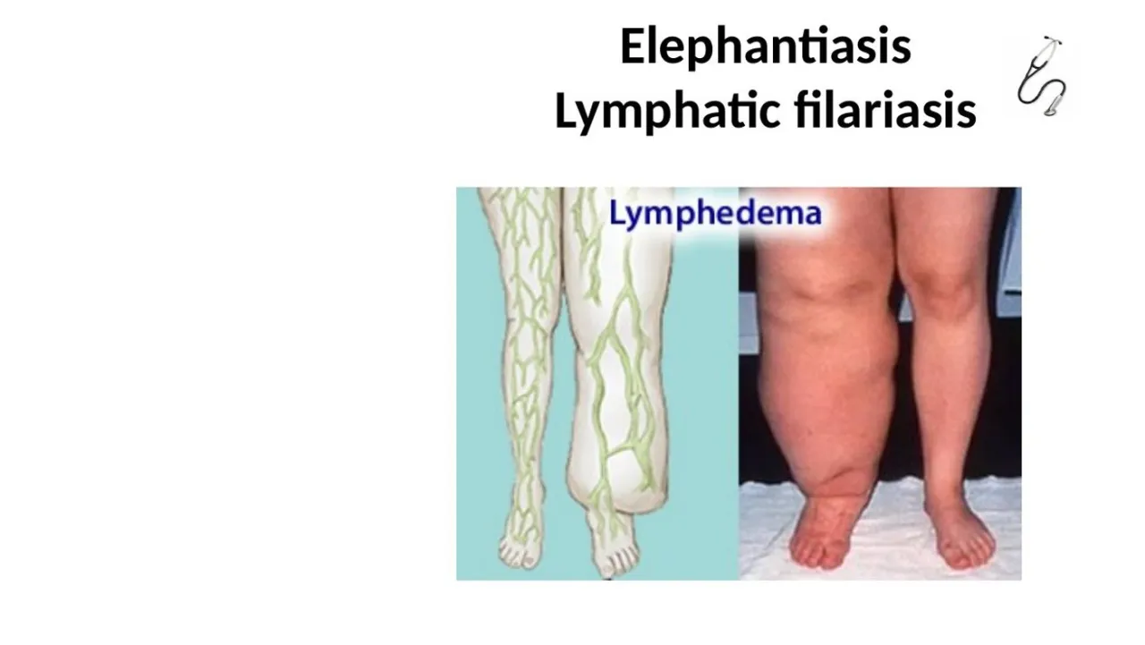 Elephantiasis: lymphatic filariasis causing massive lymphedema of the leg