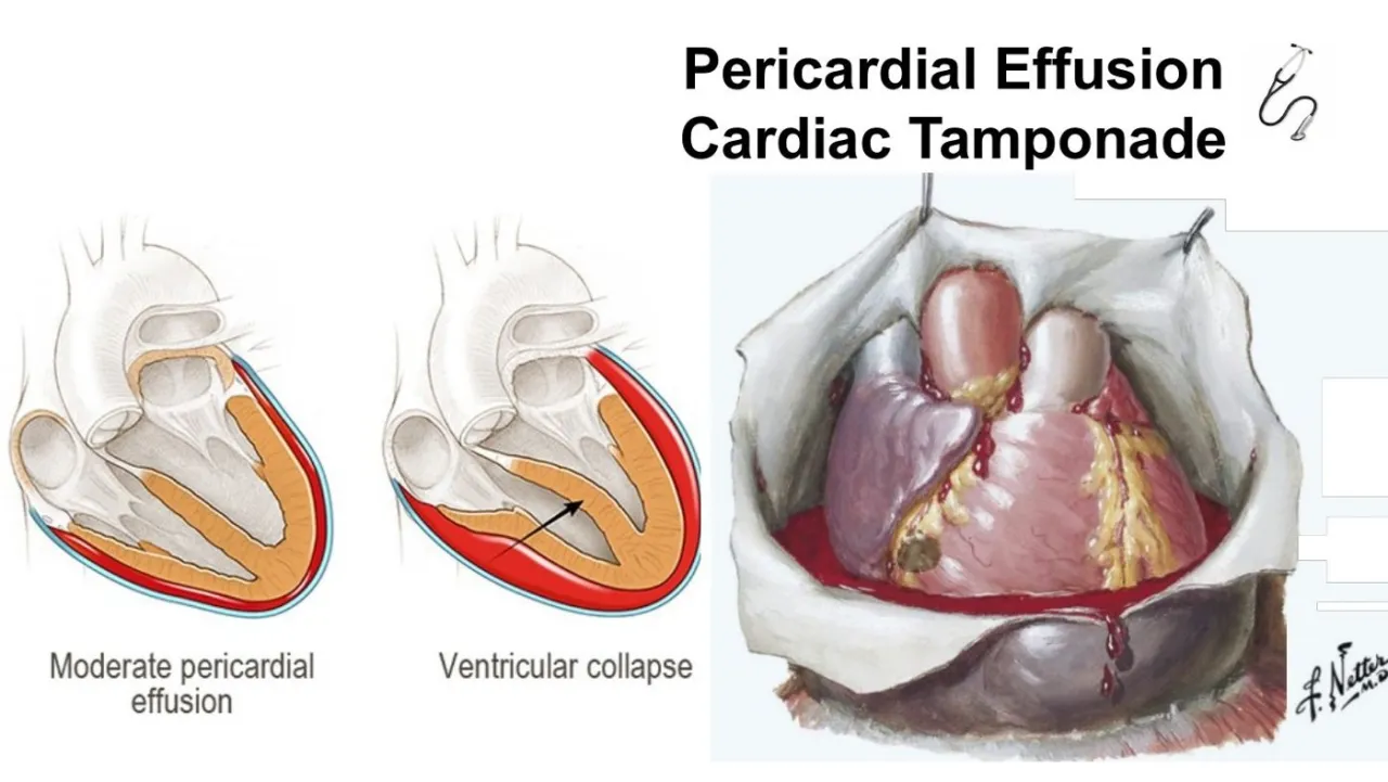 Lecture: pericardial effusion progressing to cardiac tamponade with ventricular collapse