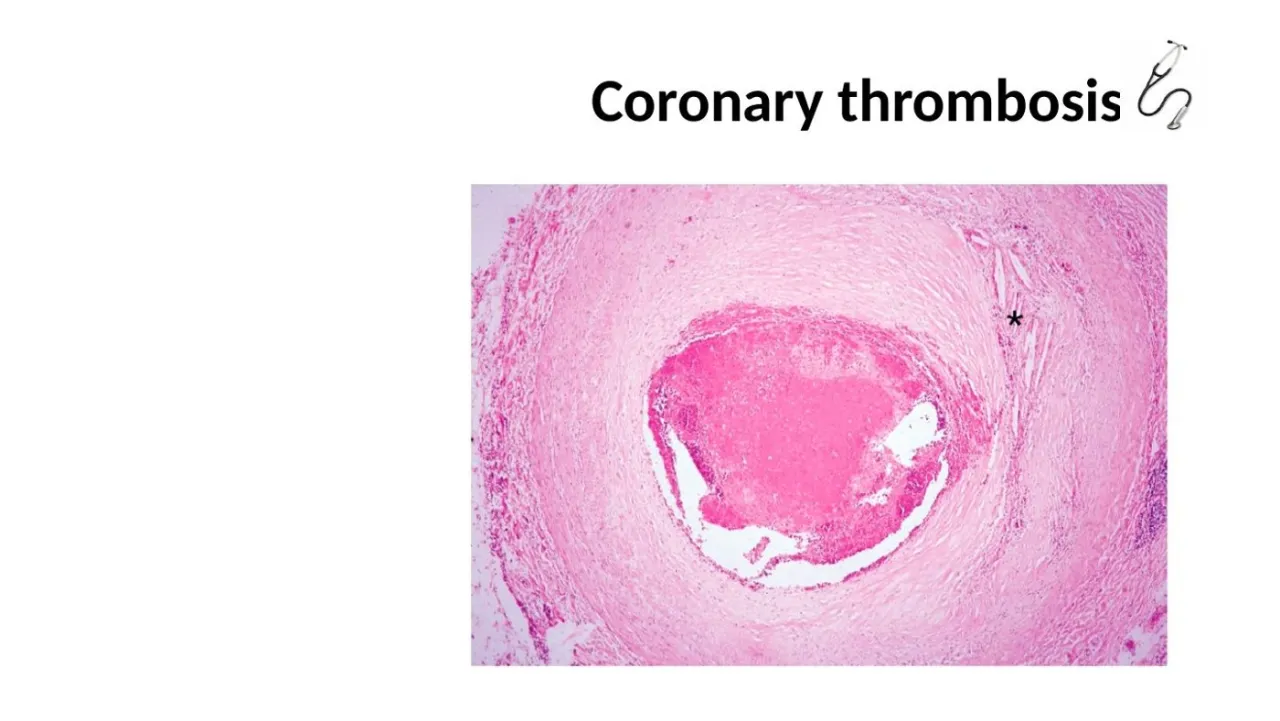 Lecture: coronary thrombosis, occlusive thrombus in a coronary artery
