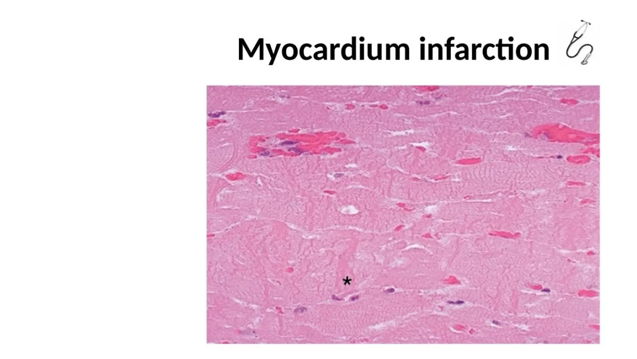 Lecture: myocardial infarction histology with hypereosinophilic fibers and contraction bands