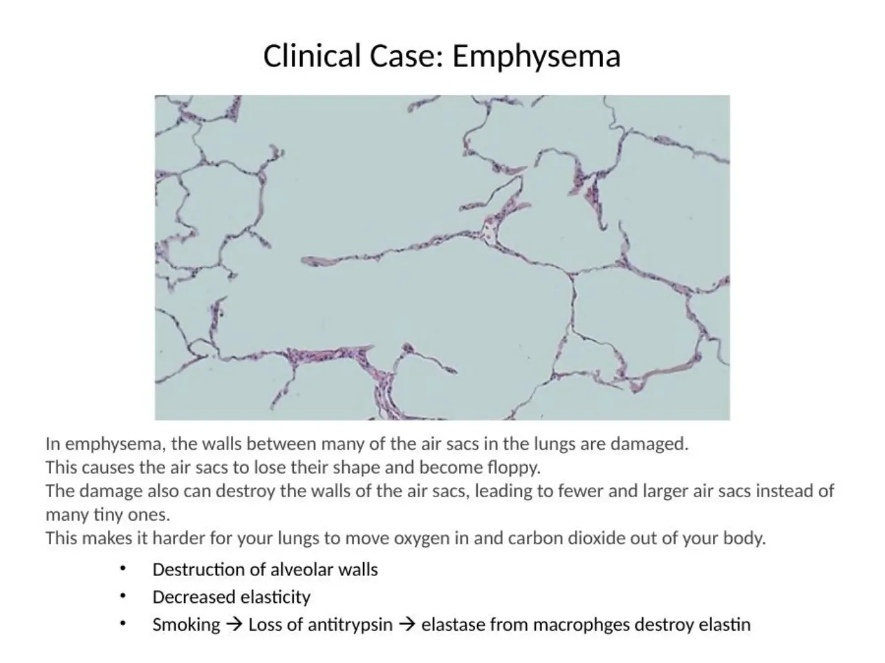 2025 review: emphysema with large air spaces and broken septa; antitrypsin loss and elastase
