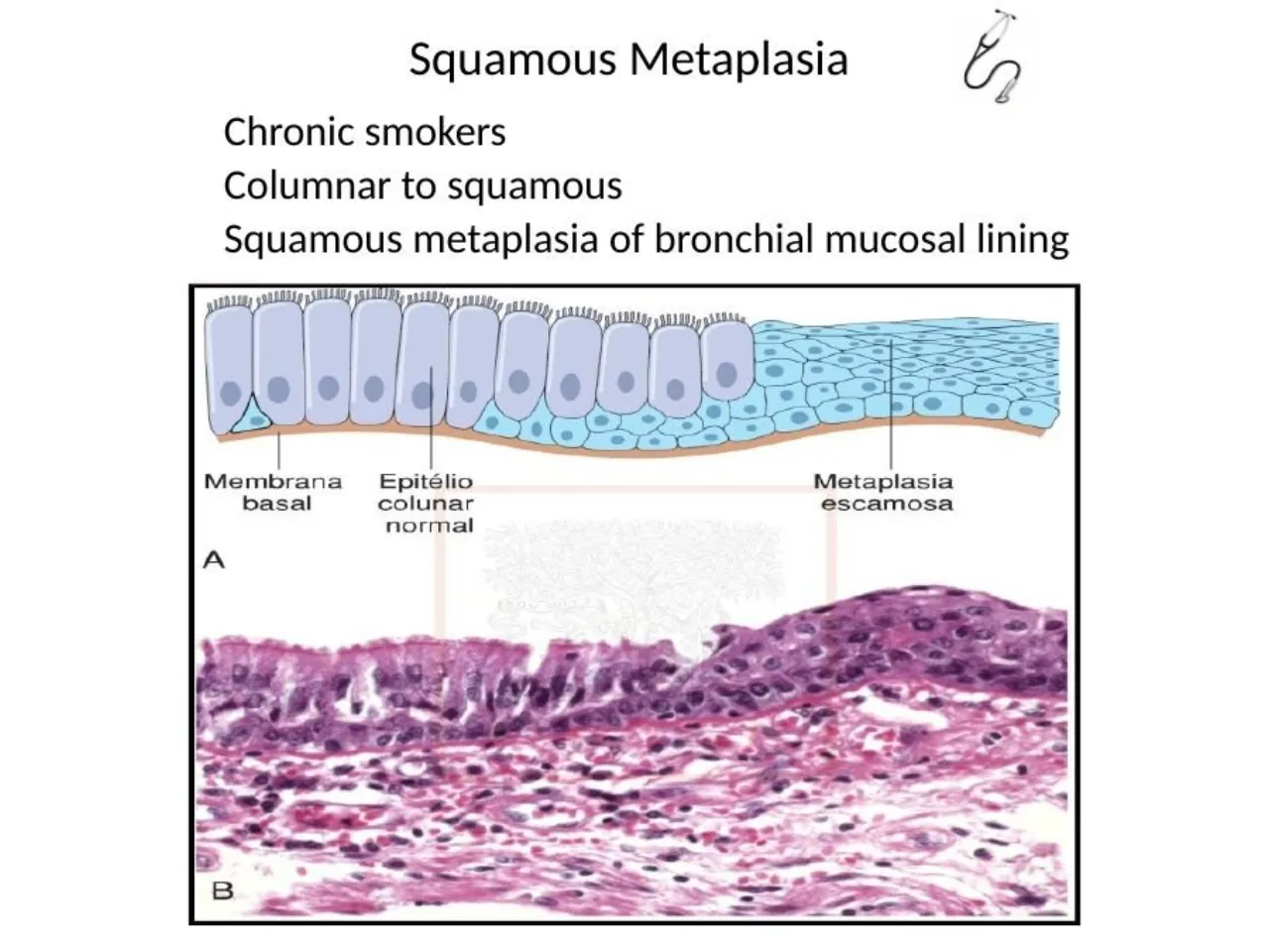 2025 lab: chronic smokers, columnar to squamous, squamous metaplasia of the bronchial lining
