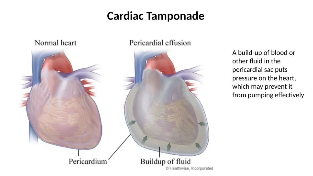 2026 lab: cardiac tamponade, fluid or blood in the pericardial sac compressing the heart