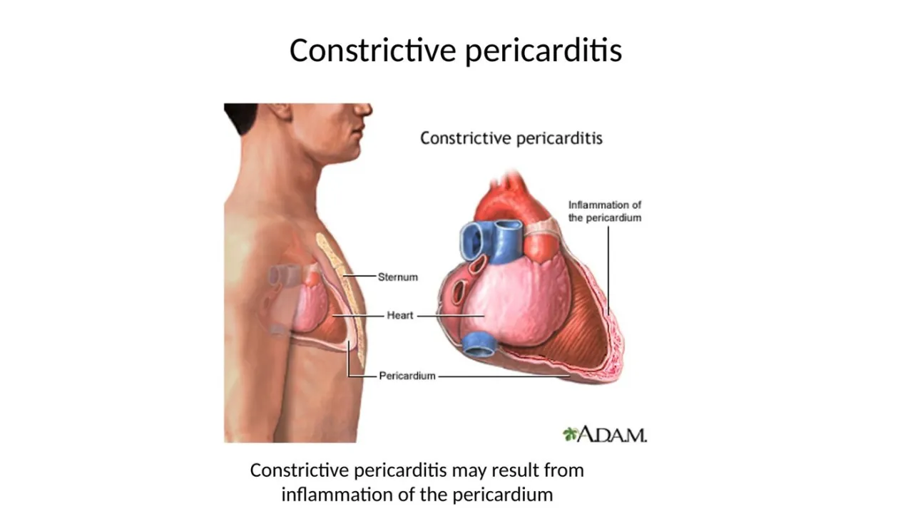 2026 lab: constrictive pericarditis, inflamed pericardium encasing the heart