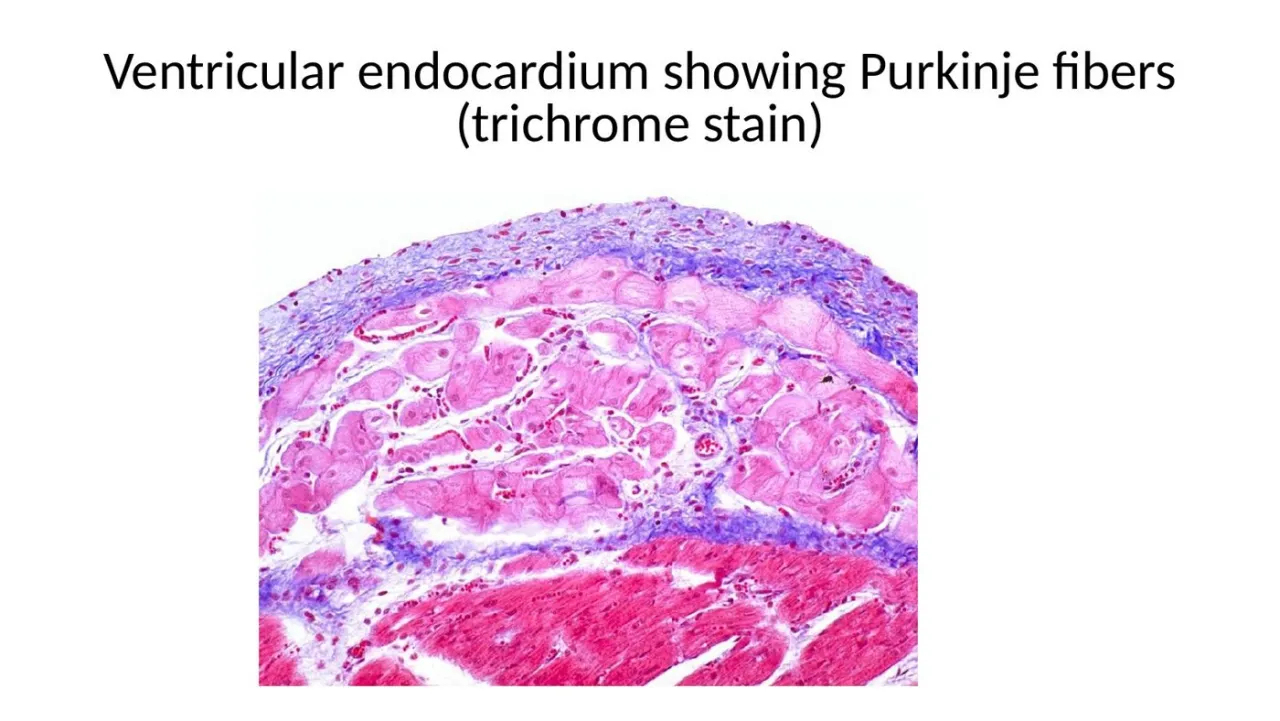 2026 lab trichrome: blue subendocardial CT with large pale Purkinje fibers over red myocardium