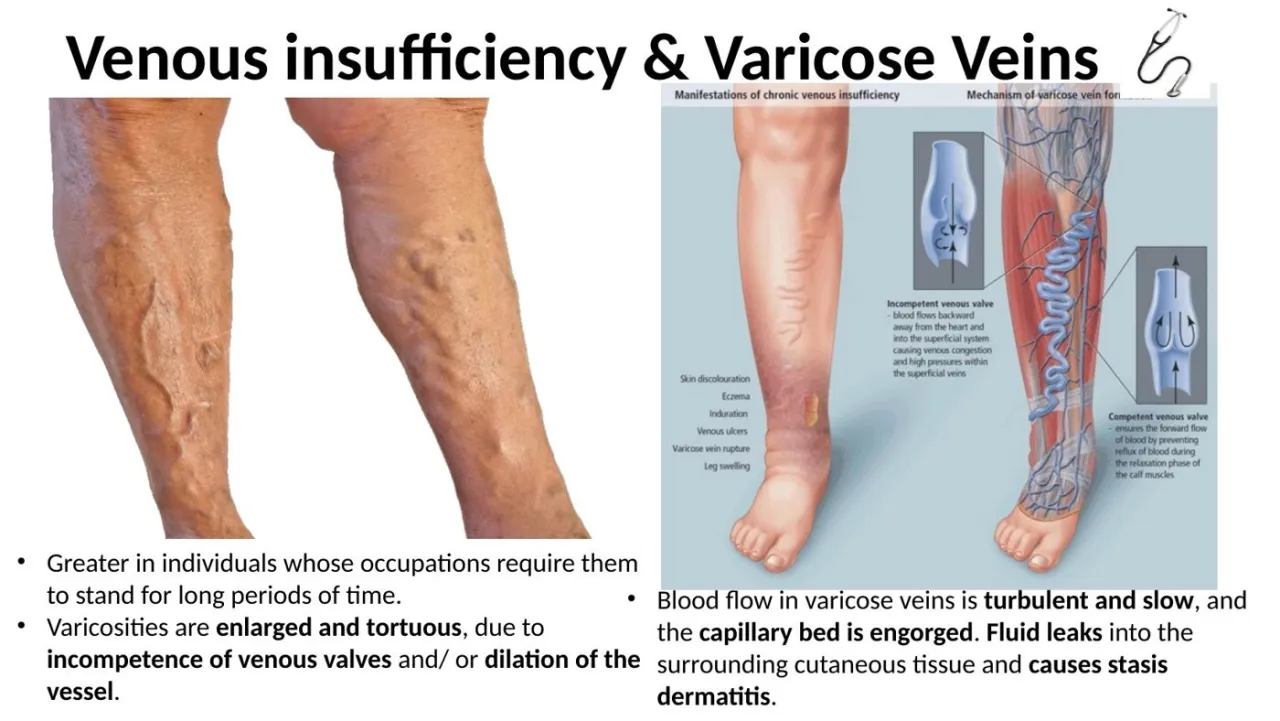 2026 lab: varicose veins, enlarged tortuous superficial veins from incompetent valves