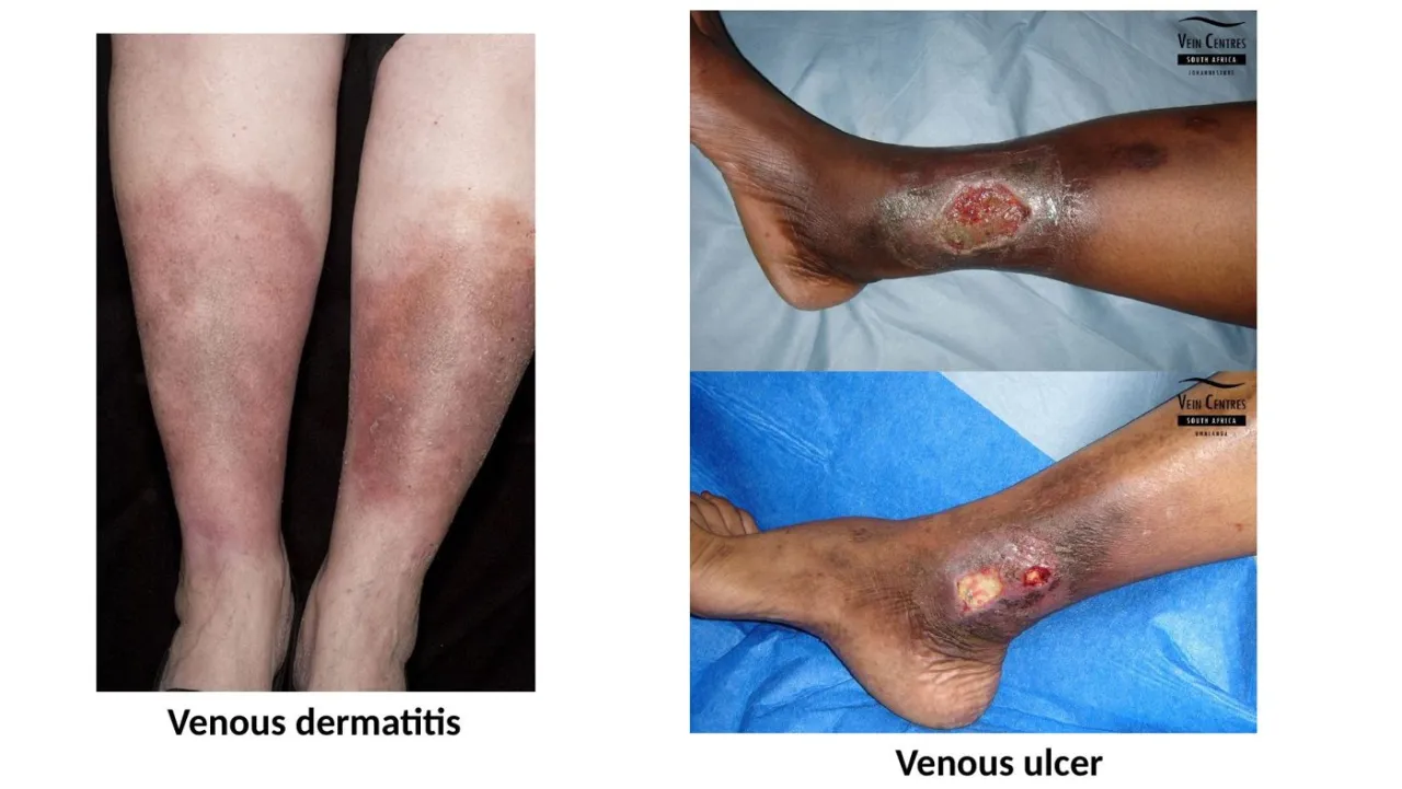 2026 lab: complications of varicose veins, venous (stasis) dermatitis and venous ulcer