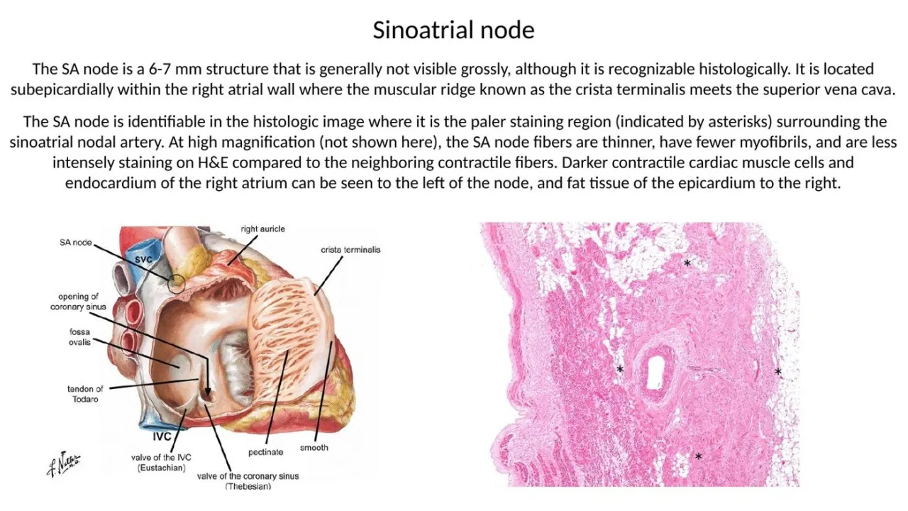 2026 session: SA node buried subepicardially in the right atrial wall at the crista terminalis