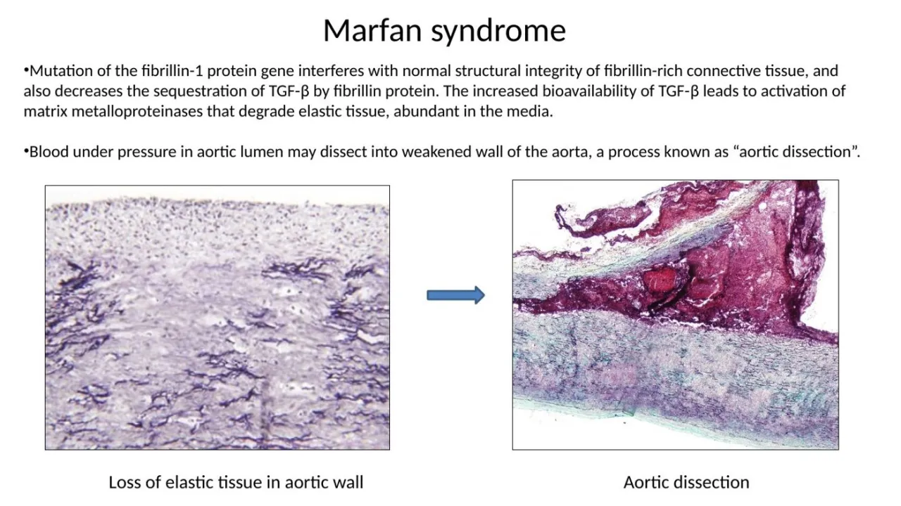 2026 session: Marfan syndrome, loss of elastic tissue in the aortic media and aortic dissection