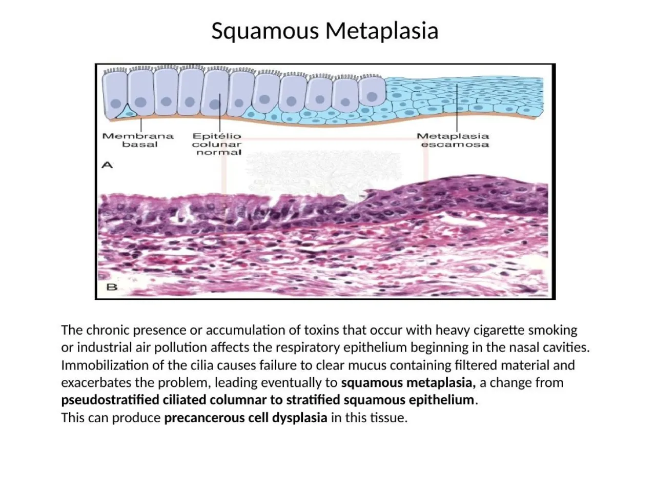 2026 lab: squamous metaplasia, pseudostratified ciliated columnar replaced by stratified squamous