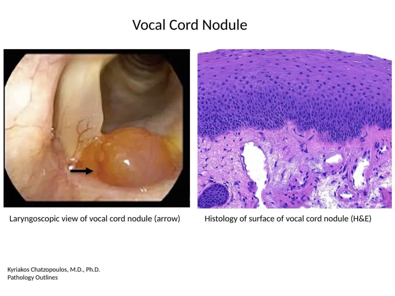 2026 session: vocal cord nodule on laryngoscopy and its stratified squamous surface on H&E