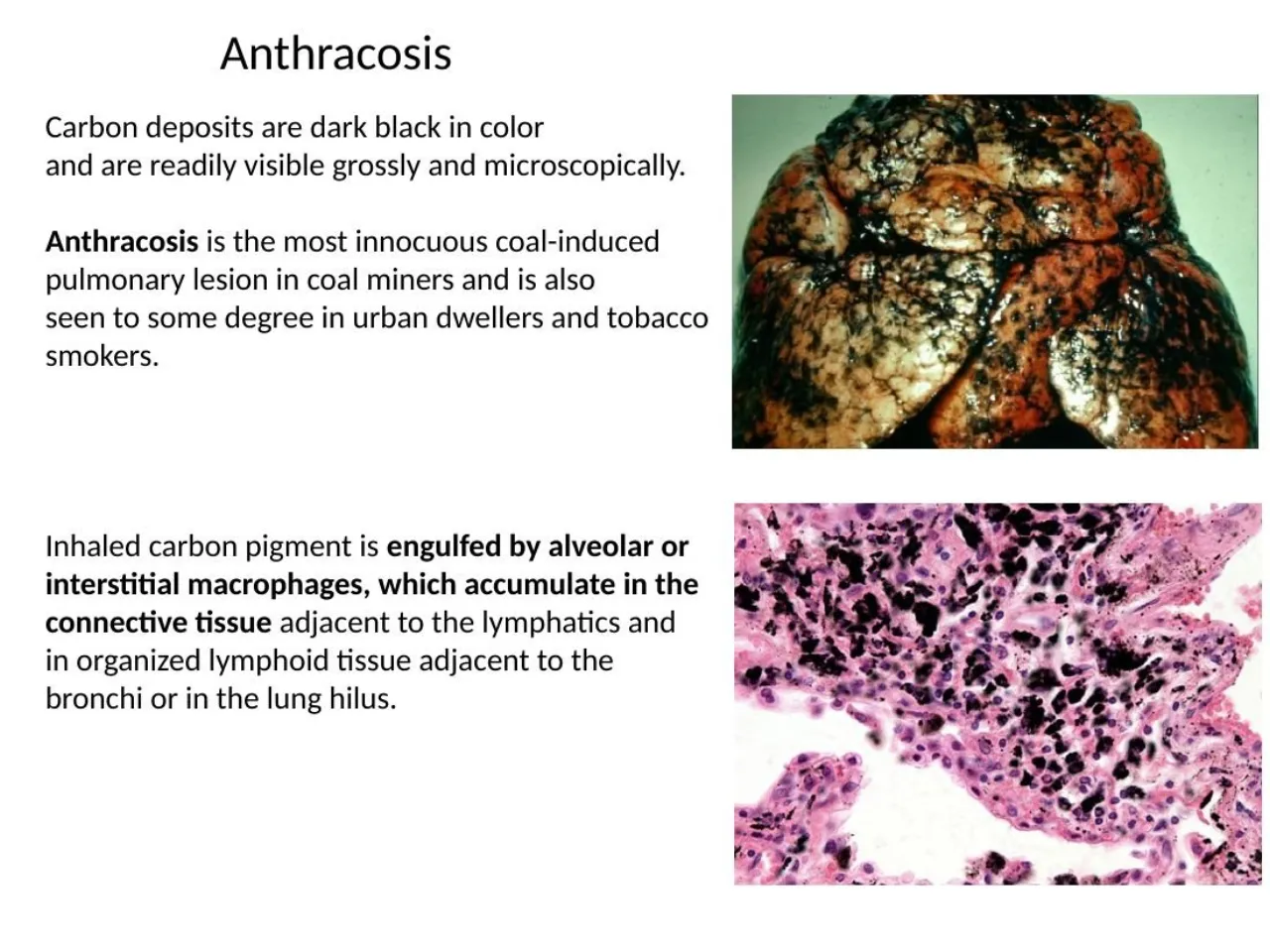 2026 session: anthracosis, carbon engulfed by macrophages that collect near lymphatics and the hilum
