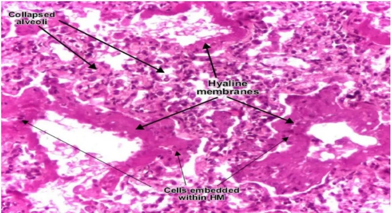 Hyaline membrane disease: collapsed alveoli and pink hyaline membranes lining air spaces