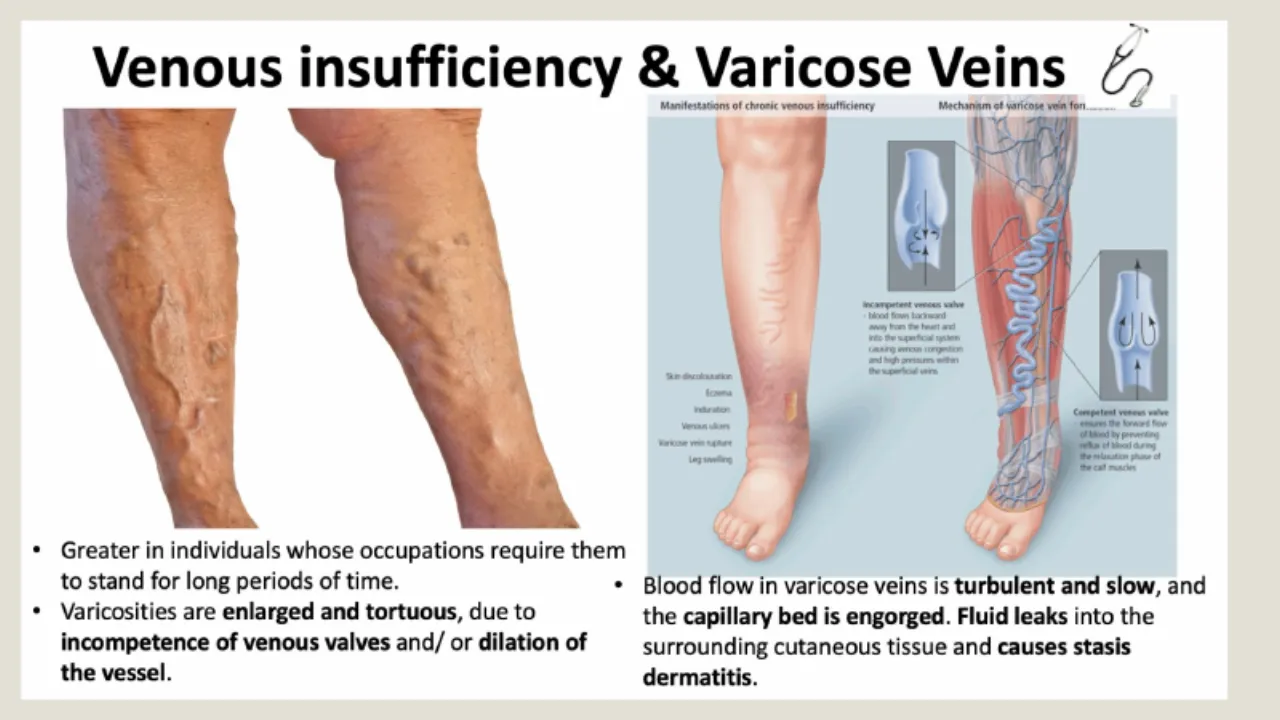 TA slide: venous insufficiency and varicose veins, slow turbulent flow and stasis dermatitis