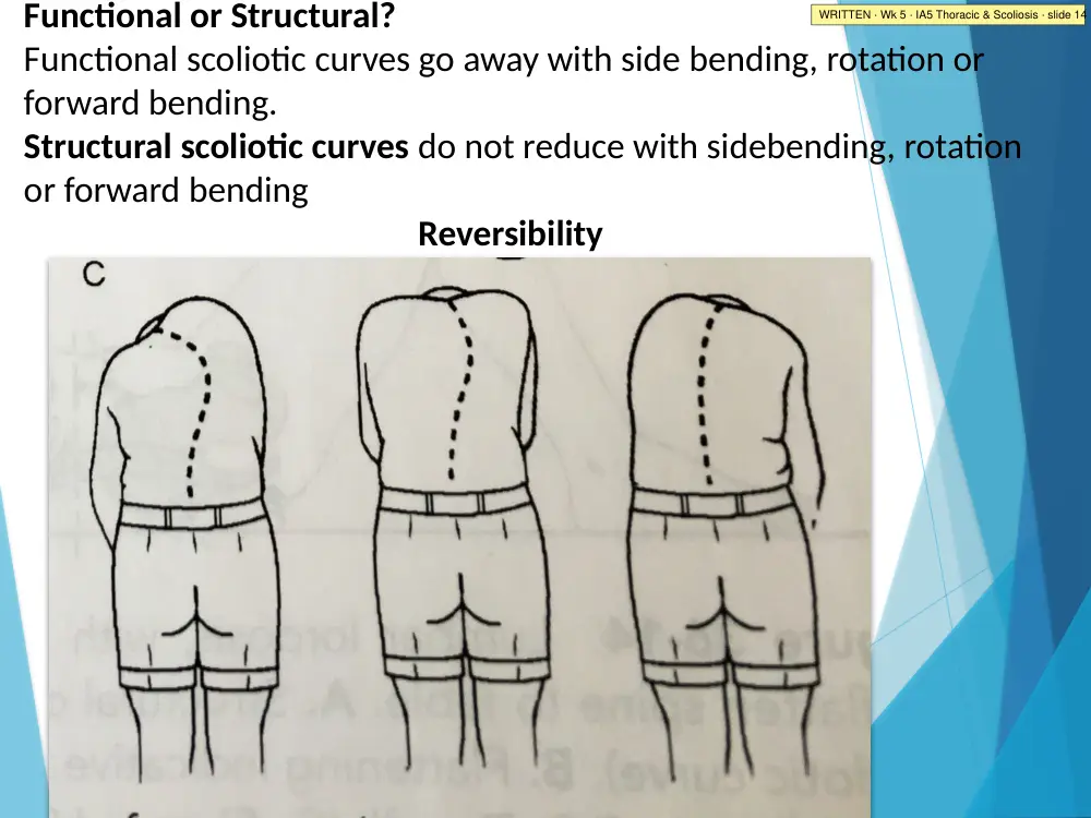 IA5 Thoracic & Scoliosis · slide 14