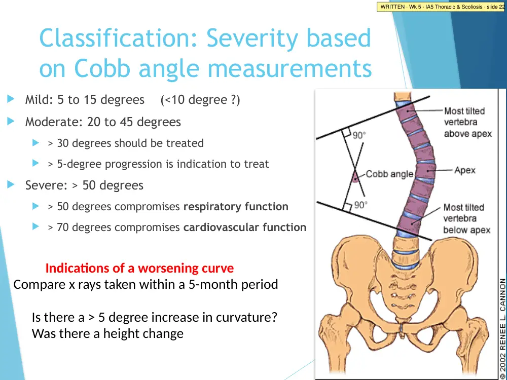 IA5 Thoracic & Scoliosis · slide 22