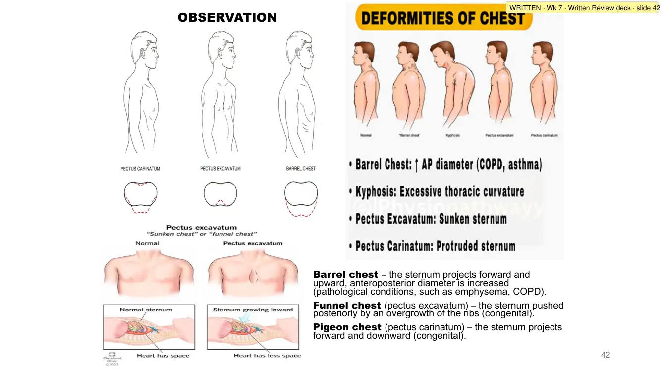 Written Review slide 42: chest deformities