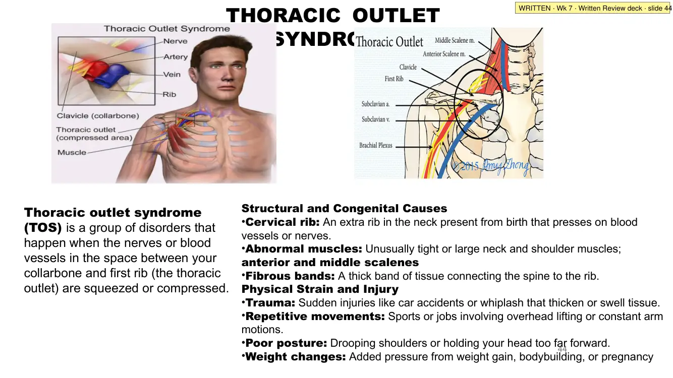 Written Review slide 44: thoracic outlet syndrome